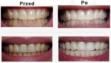 przykłady-wybielania-zębów